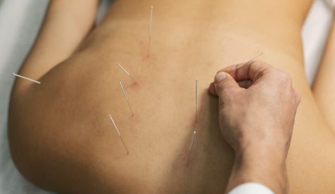 A person taking dry needling therapy for muscle pain relief