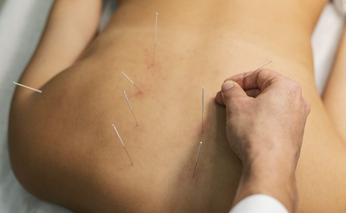 A person taking dry needling therapy for muscle pain relief