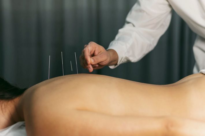 Close-up of a therapist performing dry needling by inserting a thin needle into a patient’s muscle to relieve pain and tension.