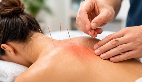 Dry needling and acupuncture therapy showing core differences for muscle pain relief and treatment methods